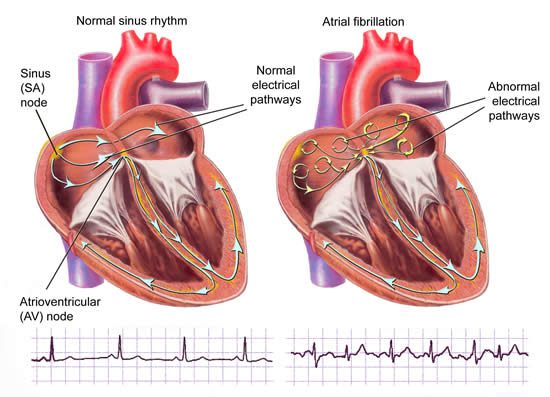 This blog mopre focus about Atrial fibrillation, Ablation for atrial fibrillation, Triggers atrial fibrillation, Irregular heartbeat, A fib treatment.