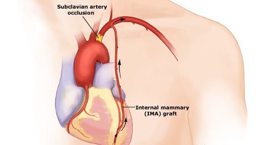 Subclavian Steal Syndrome Overview Bio And Brain Health