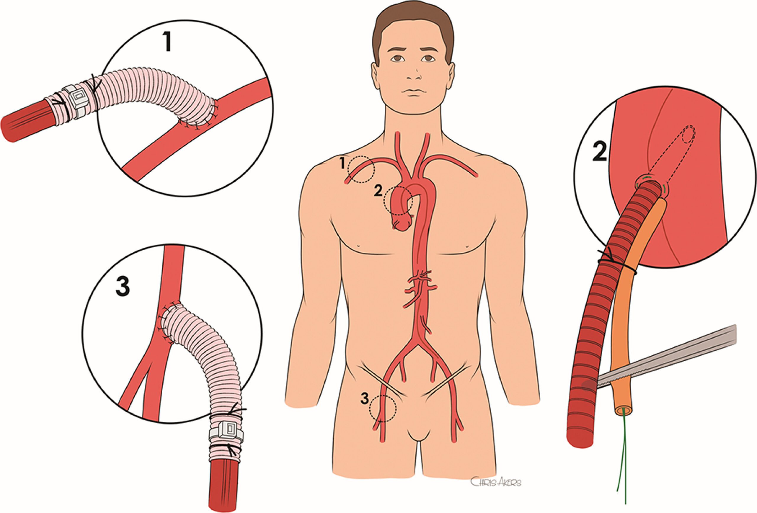 acute aortic dissection. dissecting aortic aneurysm, dissecting aneurysm, type a aortic dissection, aortic tear.