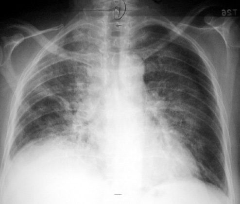 amiodarone-lung