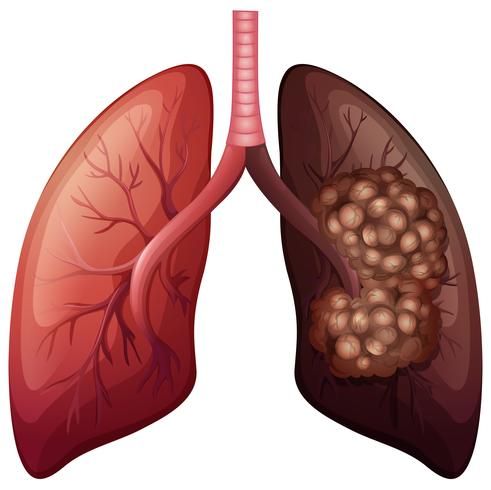 Enjoy the best info Fibrosis of the lungs, Amio lung toxicity, Pulmonary fibrosis, Amiodarone side effects, Pulmonary fibrosis treatment.