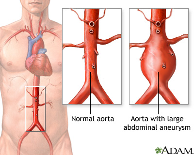 Please read this Acute aortic dissection, Aortic artery dissection, Aortic dissection disease, Aortic dissection treatment, Aortic dissection symptoms.
