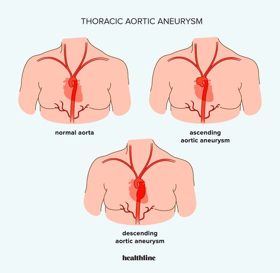 Please read this Acute aortic dissection, Aortic artery dissection, Aortic dissection disease, Aortic dissection treatment, Aortic dissection symptoms.
