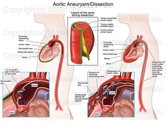 Please read this Acute aortic dissection, Aortic artery dissection, Aortic dissection disease, Aortic dissection treatment, Aortic dissection symptoms.
