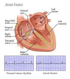 This blog mention detail info Atrial flutter treatment, Paroxysmal afib, Paroxysmal atrial fibrillation, Heart ablation for afib, Afib ablation procedure.
