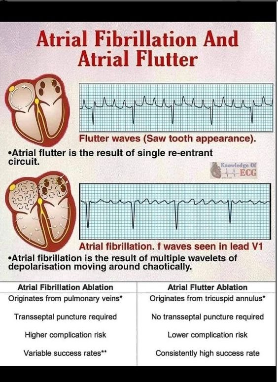 This blog mention detail info Atrial flutter treatment, Paroxysmal afib, Paroxysmal atrial fibrillation, Heart ablation for afib, Afib ablation procedure.
