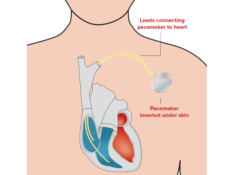 This blog focus on Pacemaker battery replacement, Battery replacement in pacemaker, Change battery in pacemaker, Pacemaker replacement, Pacemaker replacement surgery.