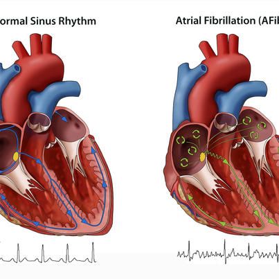 This is blog more foccus about Afib treatment options, ECG interpretations, Kardiamobile, Qardio heart health, Fibricheck.
