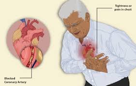 Angina symptoms