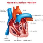 Edema and Its Impact on Body Health.