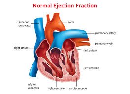 ejection fraction