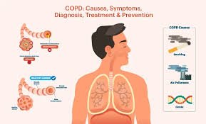 COPD Symptoms You Should Not Ignore