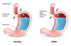 gerd symptoms