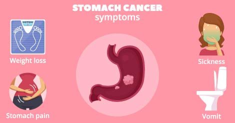 stomach cancer symptoms