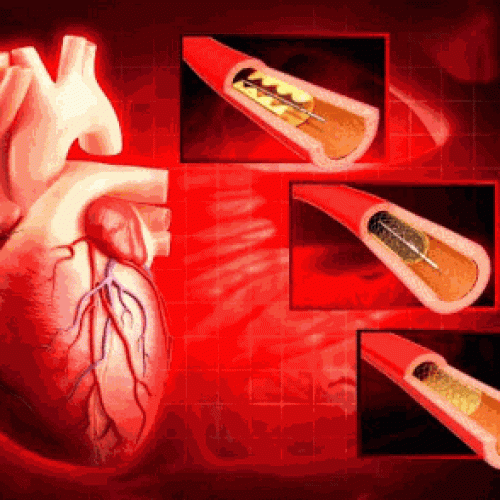 Here we cover this point in detail information
Stent in heart, Stunt of heart, Stent placement, Stent surgery, Stent operation.
